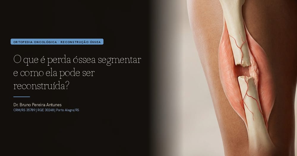 O que é perda óssea segmentar e como ela pode ser reconstruída?