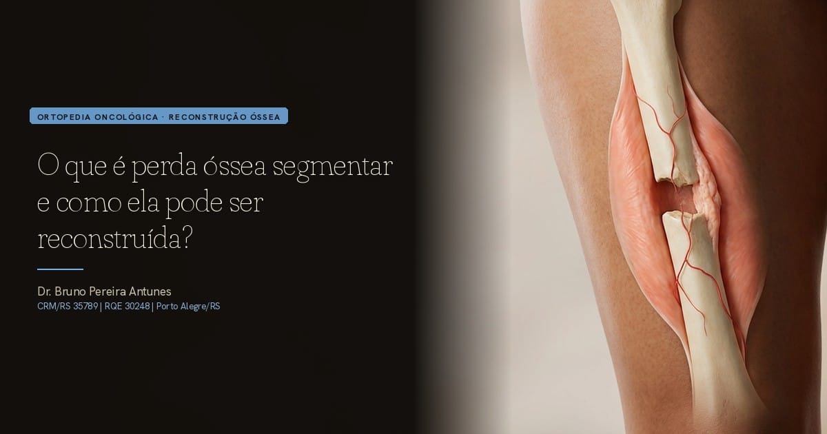 O que é perda óssea segmentar e como ela pode ser reconstruída?